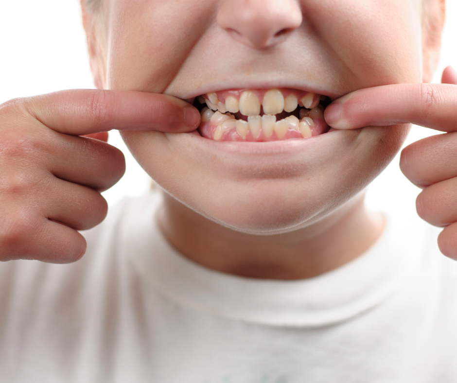 When to Worry About Crooked Teeth