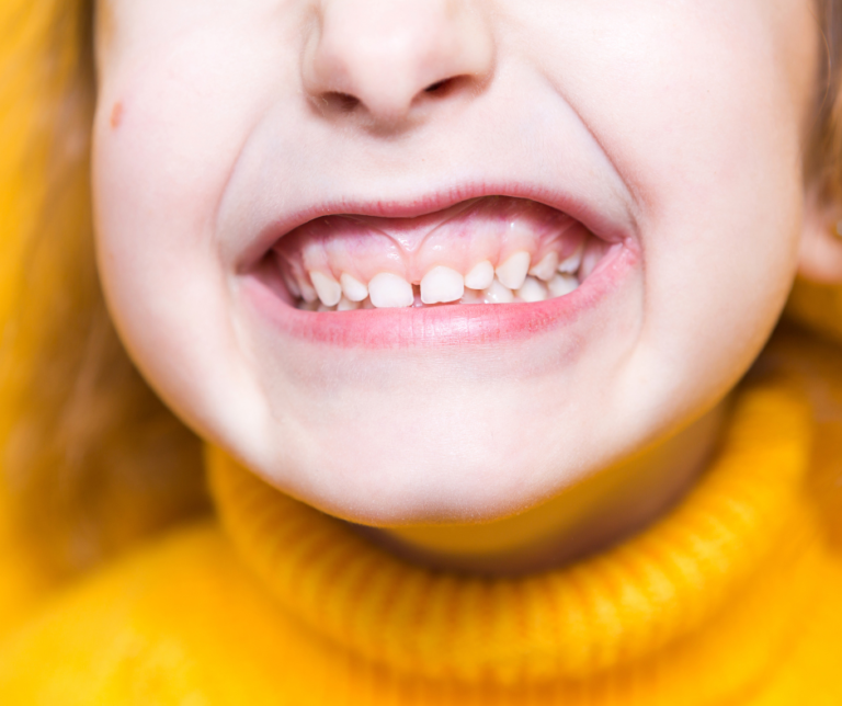 Signs of an Overbite or Underbite in Children – Fort Dental