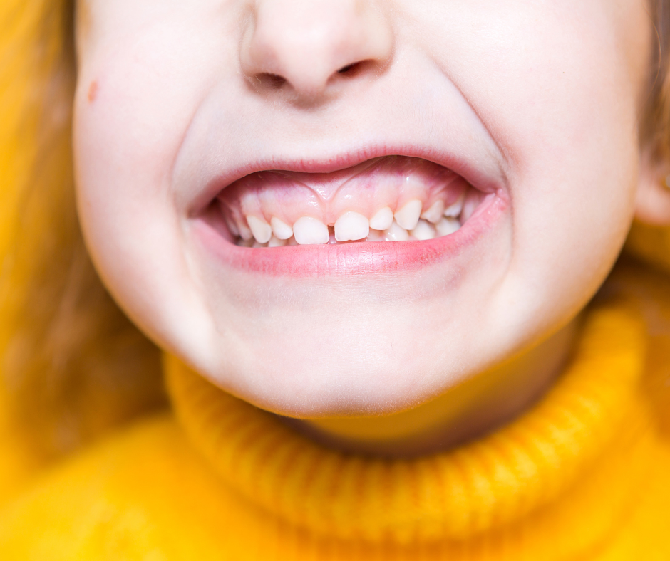 Signs of an Overbite or Underbite in Children